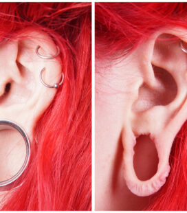 Toronto otoplasty, Toronto ear repair, over stretched earlobe, spacers