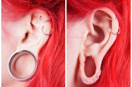 Toronto otoplasty, Toronto ear repair, over stretched earlobe, spacers