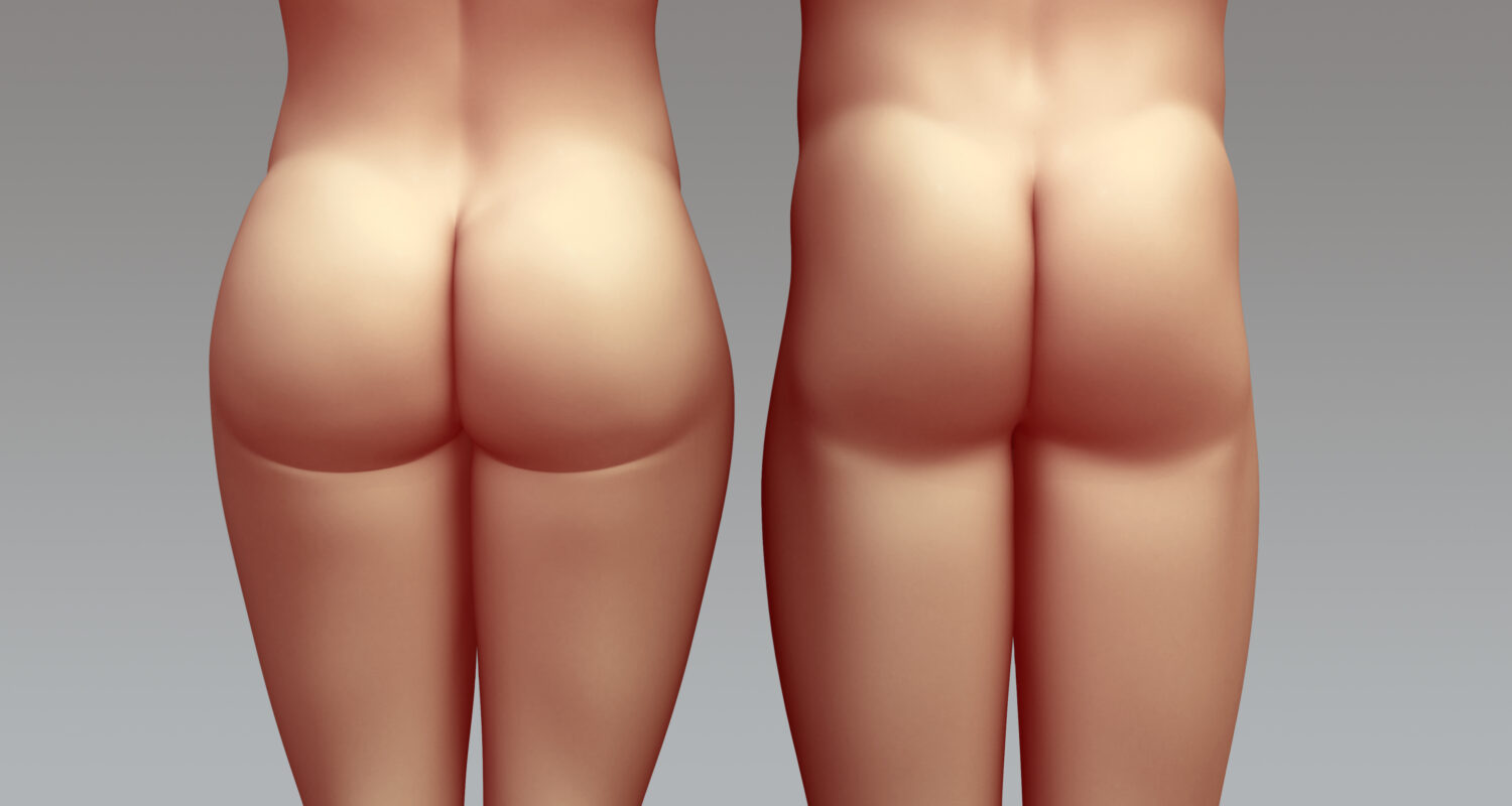 Buttock augmentation, Butt lift, Toronto buttock augmentation, buttock implants Toronto