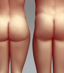 Buttock augmentation, Butt lift, Toronto buttock augmentation, buttock implants Toronto