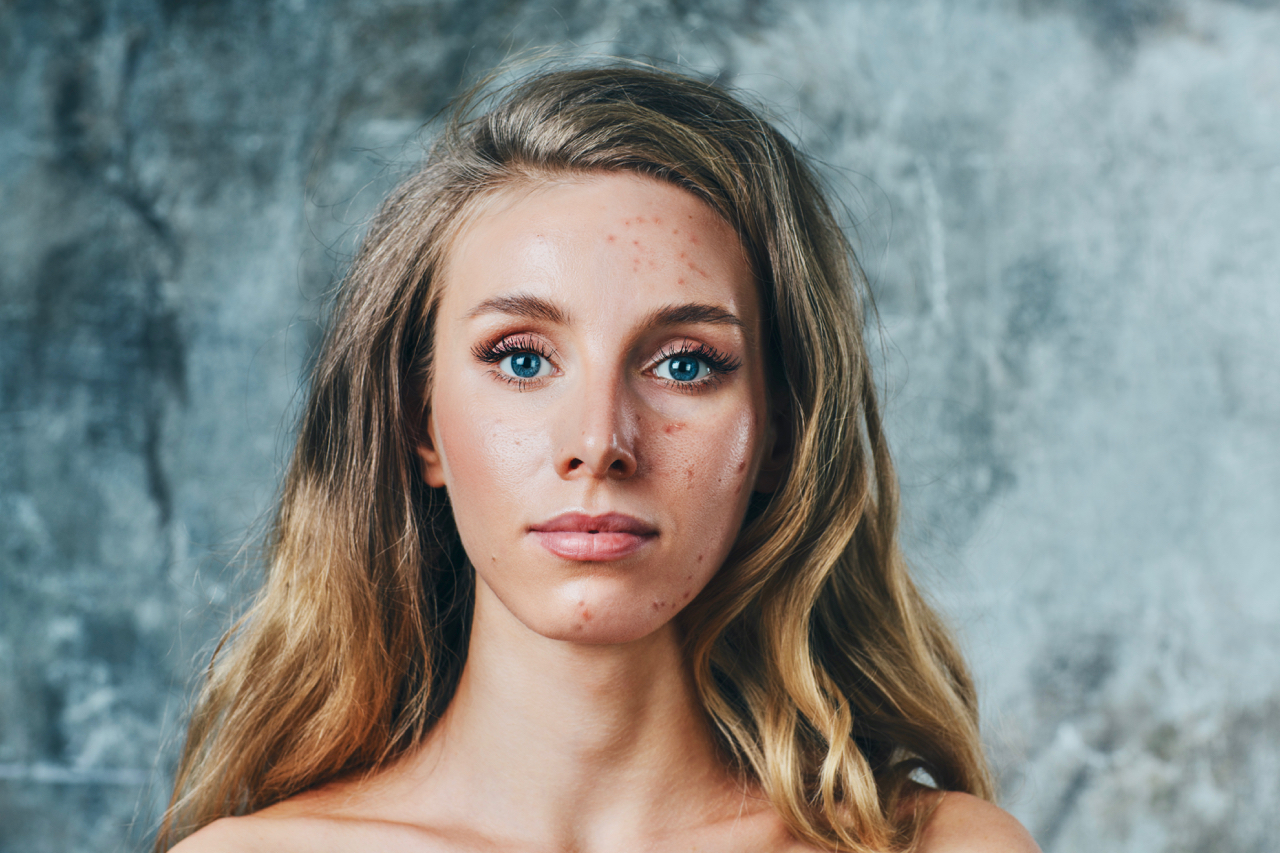 Acne Toronto, Toronto acne, Skin care Toronto, Toronto skin care